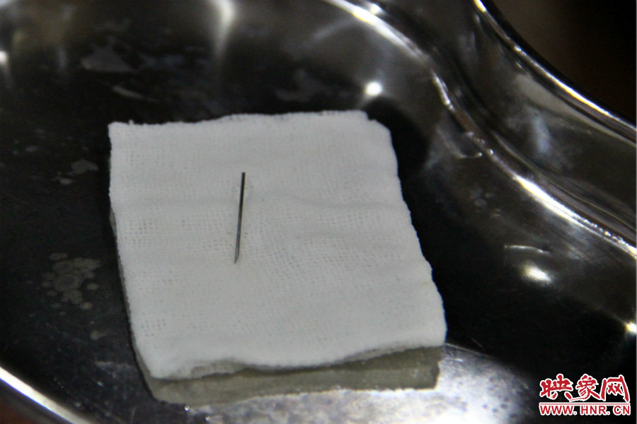 上午11點(diǎn)30分許，小龍腦中鋼針已經(jīng)成功取出。