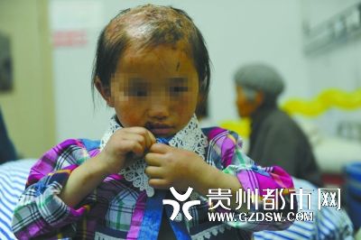 被燙傷的頭皮一直沒有愈合。