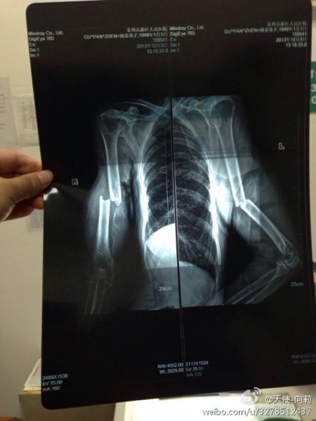 圖為微博上傳“范某某的妻子顧盤珍手被打斷?！? width=