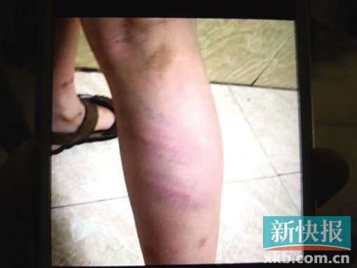 小宇腿部有明顯瘀痕。 翻拍自家屬手機