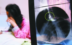 假牙上的鋼絲刺破食管，而薄薄的食道壁緊貼主動脈血管，極易造成血管破裂