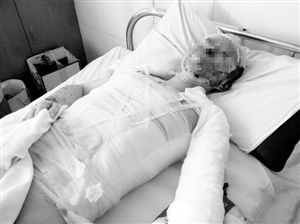 周小姐的頭、頸、軀干、四肢均被燒傷，其中面部燒傷最為嚴(yán)重。