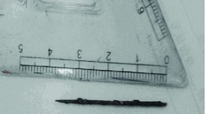 取出的繡花針已發(fā)黑生銹。