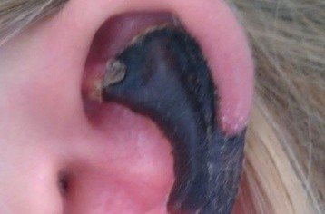 荷蘭女子旅游途中被蜘蛛咬，耳軟骨溶解變黑。