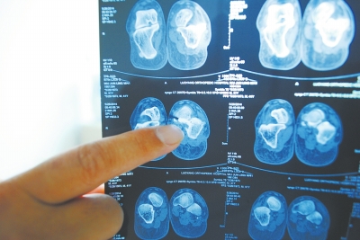 X光片顯示,確實有一根殘留的螺絲釘。