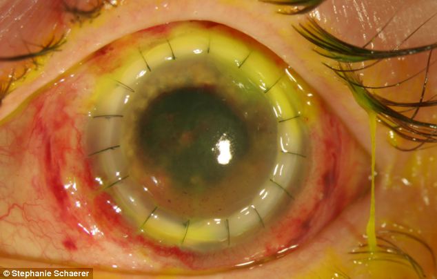 恐怖慎入！隱形眼鏡致英女子摘除眼球