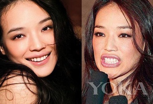 牙齒凸出，口輪肌過(guò)于松弛