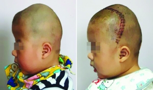 術(shù)前（左），術(shù)后（右）