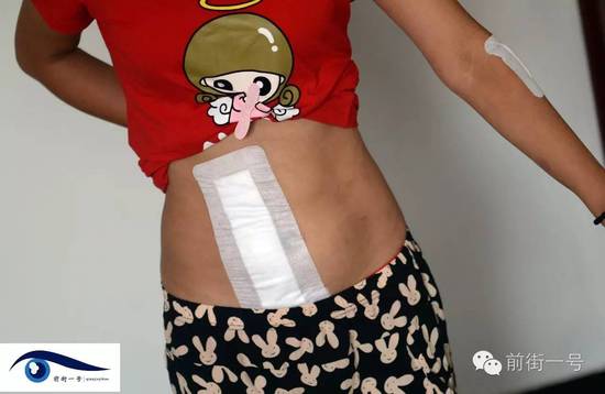 小金腹部的傷口。