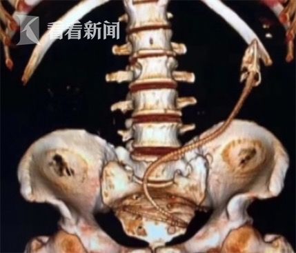 黃鱔從肛門(mén)鉆進(jìn)肚子 男子被送醫(yī)不愿多談事情經(jīng)過(guò)