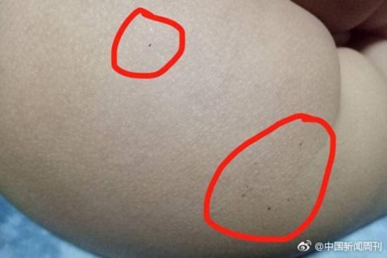 據(jù)多名紅黃藍(lán)(新天地分園)家長(zhǎng)反映，孩子腿部、屁股、腋下出現(xiàn)針眼。