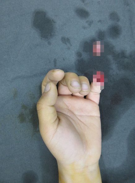 嚇哭！6歲男孩被夾斷手指 罪魁禍?zhǔn)拙故切７? oldsrc=