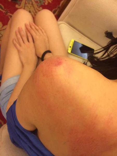 “跑男”真的很拼！baby朋友圈曬后背紅腫照