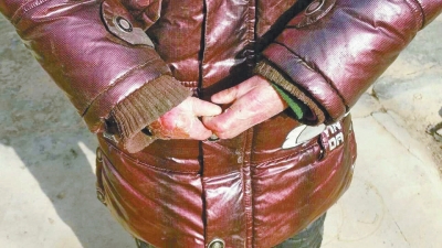 長(zhǎng)期受損的手指，已經(jīng)長(zhǎng)在了一起。