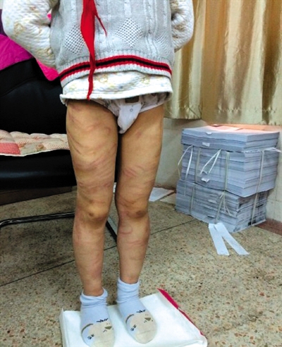 4月3日晚，微博網(wǎng)友“@朝廷半日閑”發(fā)圖文微博展示男童被虐待的慘狀。 微博截圖