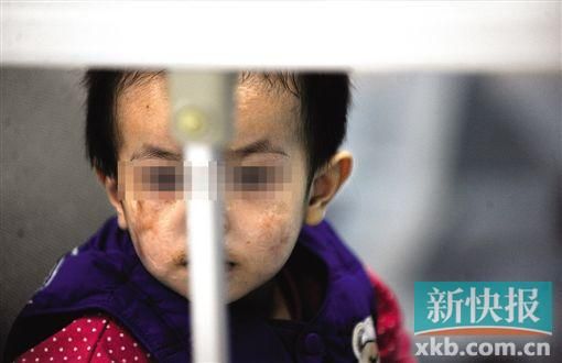 去年3月就能出院的小華(化名),目前還在廣州市婦兒醫(yī)療中心的PICU里住著。新快報(bào)記者 孫毅/攝