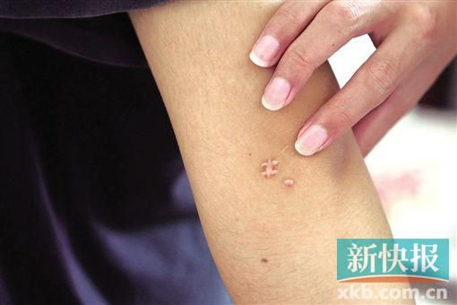 取出針后李星兒手臂留下了傷口。新快報記者 張國鋒/攝