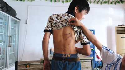 　昨日，奶西村，被打的小剛后背上條條瘀痕依然明顯。