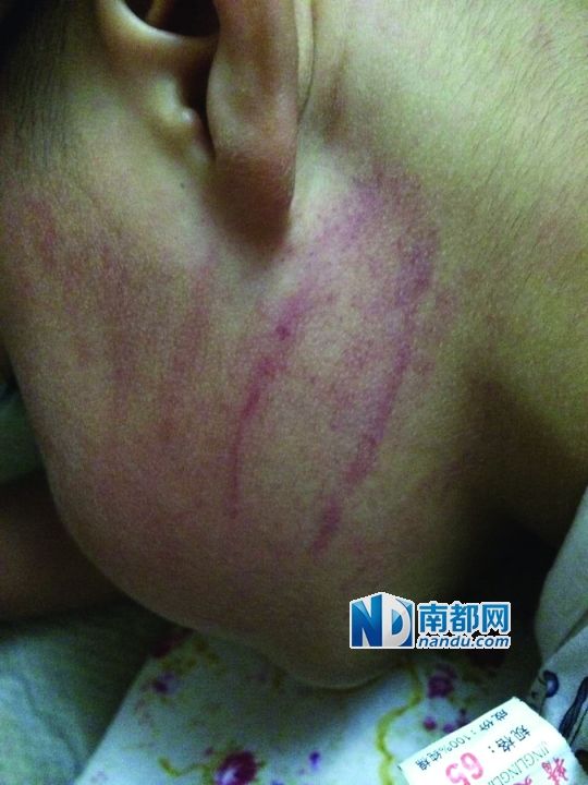 小逸臉上淤痕清晰可見。