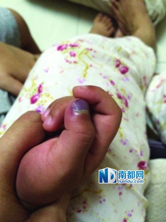 小逸手指被夾傷。