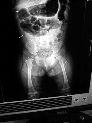 目前體內(nèi)的12根鋼針多分布在孩子的臀部，一根在腹部，其余3根在胸腔附近，其中一根很接近心臟