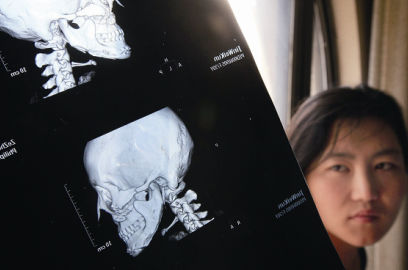 國內醫(yī)院CT顯示，如今靳魏坤的鼻子假體是歪的，連下巴也是歪的