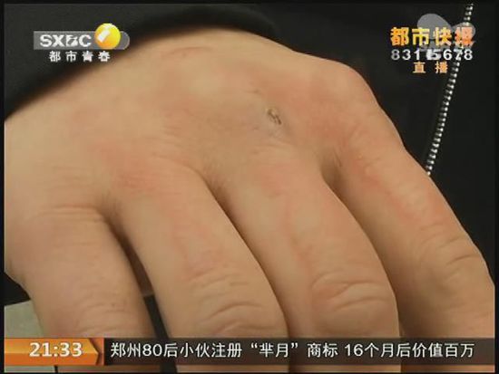 說到這足療拔罐，估計大伙都不陌生，但是想起4號晚上的拔罐的經歷，呂先生現(xiàn)在想起來，還心有余悸。