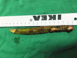 插入男子腦內(nèi)的樹枝。