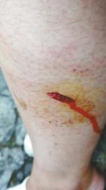 郭女士腿上被猴子咬的傷口。(受訪者供圖)