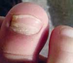 一幼兒園兒童“指甲異?！? title=